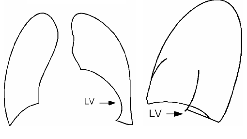 Hở van động mạch chủ