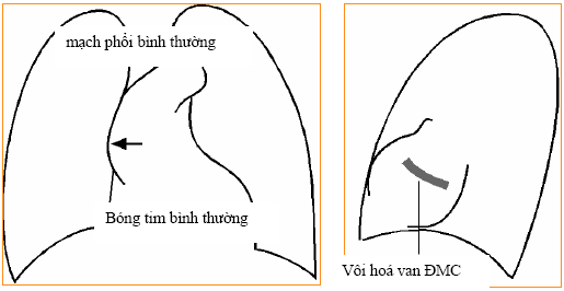 Hẹp van động mạch chủ