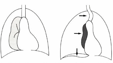 Tràn khí màng phổi (trái), tràn khí màng phổi có van (phải)