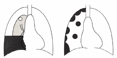 Tràn khí màng phổi (trái), u màng phổi (phải).