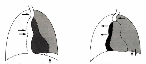 Xẹp phổi trái do tắc hoàn toàn phế quản gốc (trái), tràn dịch màng phổi trái (phải).