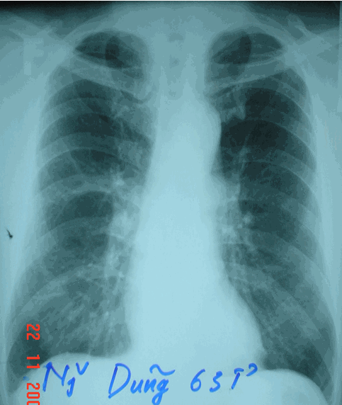 Hình ảnh phổi ngoài cơn hen trên cùng một bệnh nhân - Hen phế quản