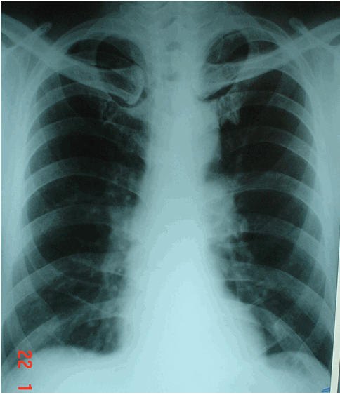 Hình ảnh hai phổi rất sáng do ứ khí trong cơn hen ở bệnh nhân nam, 63 tuổi -  Hen phế quản