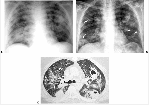 Viêm phổi nocardiosis ở người ghép thận