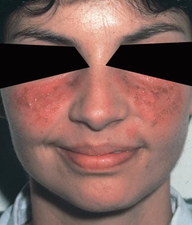 Ban cánh bướm trong bệnh lupus ban đỏ hệ thống