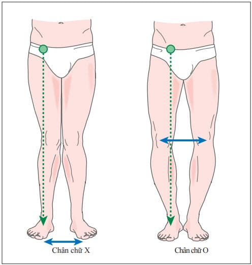 Biến dạng chân chữ X và chân chữ O