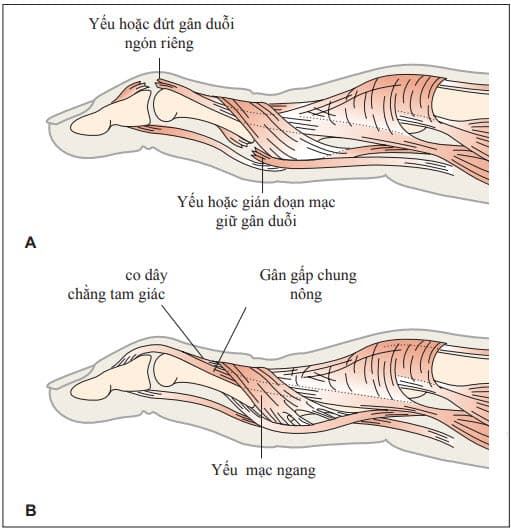 Biến dạng ngón tay hình cổ ngỗng