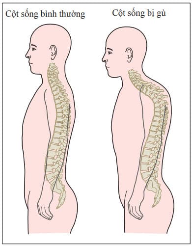 Cột sống bình thường và cột sống bị gù