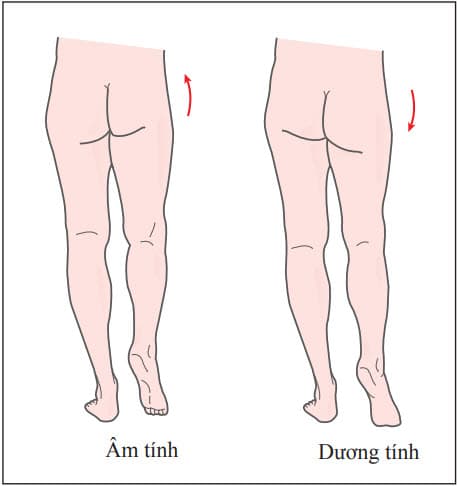 Dấu hiệu Trendelenburg