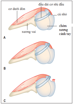 Dấu hiệu yergason