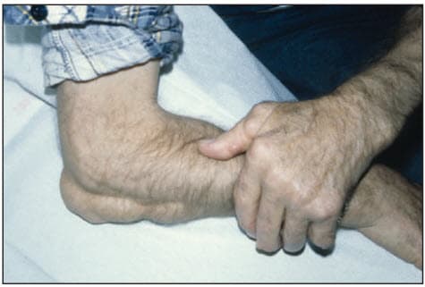 Hạt thấp dưới da lớn ở mặt dưới của cánh tay