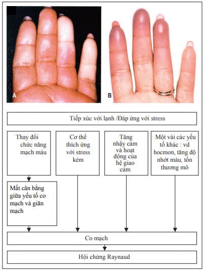 Hội chứng Raynaud