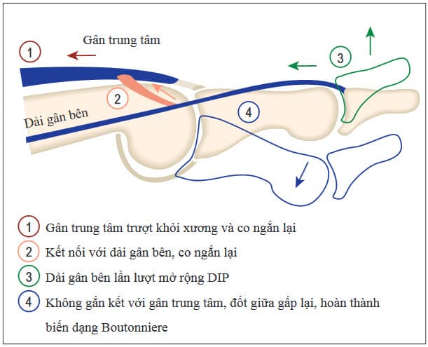 Sinh lý bệnh của biến dạng boutonniere