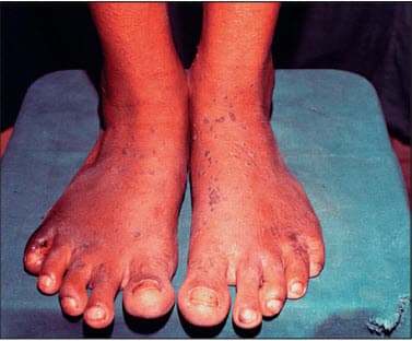 Viêm ngón chân ở bệnh nhân bị viêm khớp vẩy nến