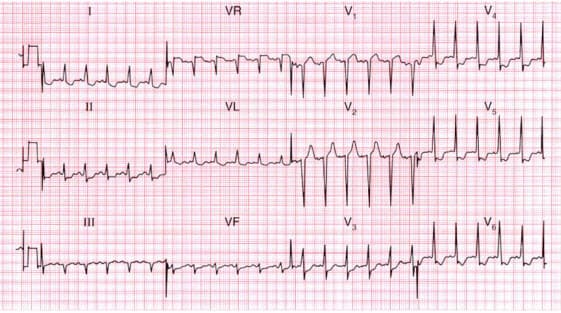 Đau thắt ngực không ổn định: hình ảnh điện tâm đồ