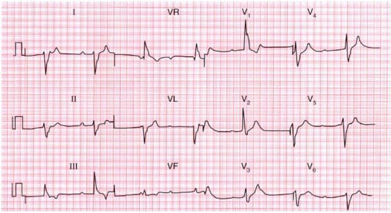 Block nhĩ thất cấp 3