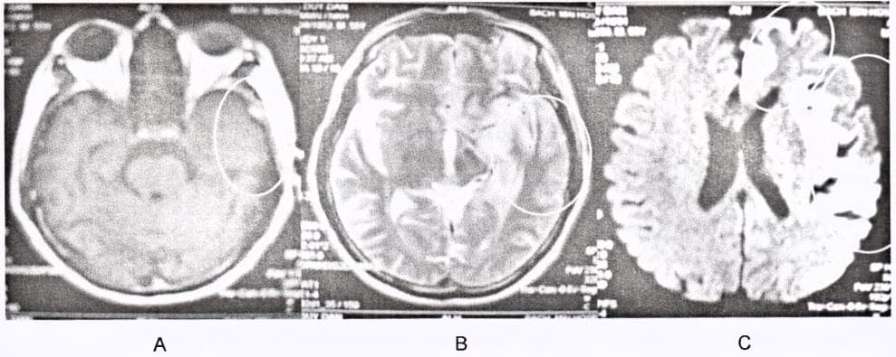 MRI sọ não