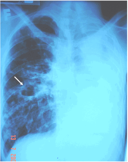 Hình ảnh  lao hang phổi phải có mức nước mức hơ