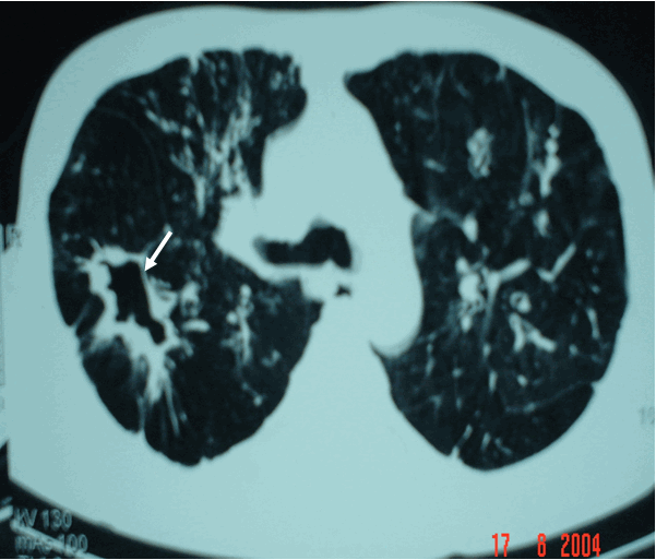 Hình ảnh lao hang phổi phải trên phim CT