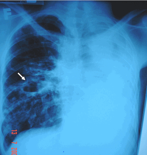 Hình ảnh lao hang phổi phải có mức nước mức hơi & xẹp toàn bộ phổi trái