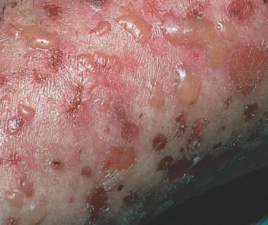 Bọng nước dạng Pemphigus