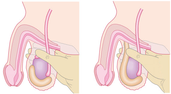 Đánh giá sự xuất phát khối sưng vùng bìu