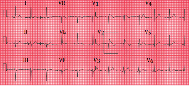Hội chứng Brugada