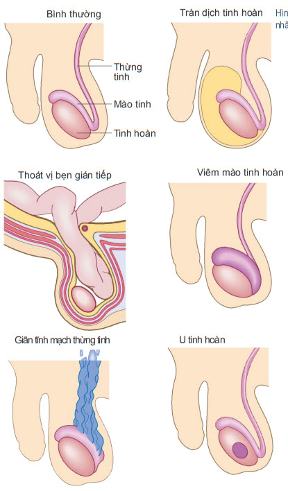 Những nguyên nhân thường gây sưng bìu