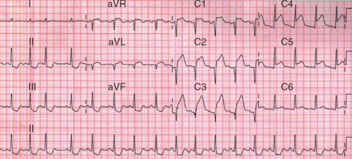 Nhồi máu cơ tim cấp vùng thành trước với ST chênh lên