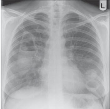 Tổn thương lỗ khuyết ở phổi