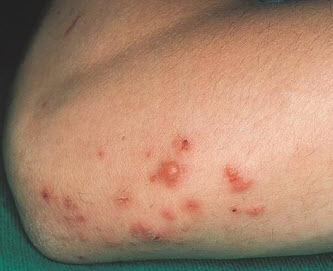 Viêm da dạng herpes