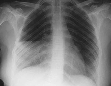 Viêm thùy giữa phổi phải
