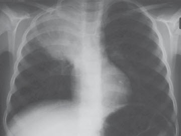 Viêm thùy trên phổi phải với hình ảnh khí nội phế quản