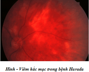 Bệnh mắt Vogt-Koyanagi-Harada