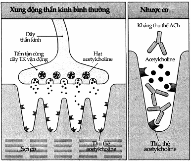 Bệnh nhược cơ nặng.