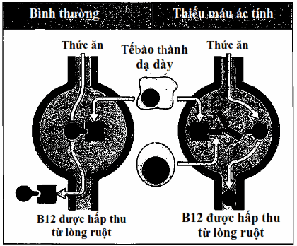 Mất hấp thu vitamin B12 trong bệnh thiếu máu ác tính.