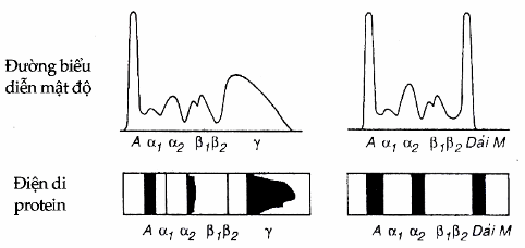 Phân tích điện di protein bằng mật độ kế để định lượng dải M (A= albumin)