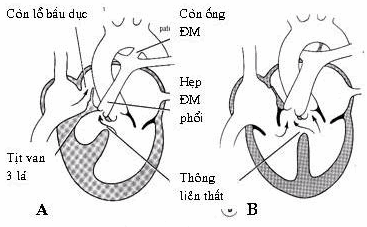 A. Tịt van ba lá; B. Bất sản đoạn màng vách liên thất