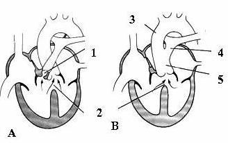 A. Tứ chứng fallot; B. Thân chung động mạch