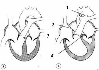 A. Hẹp van động mạch chủ; B. Tịt van động mạch chủ