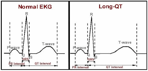 Khoảng QT bệnh lý