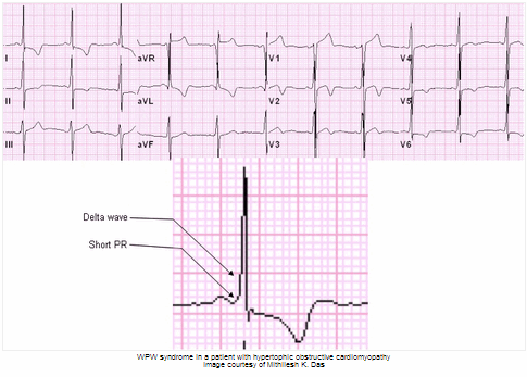 Hình ảnh hội chứng Wolf Parkinson White