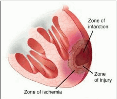 Vùng cơ tim bị nhồi máu có một vùng đứng giữa bị hoại tử, rồi đến một vùng tổn thương bao quanh nó và ngoài cùng là một vùng thiếu máu bao quanh vùng tổn thương