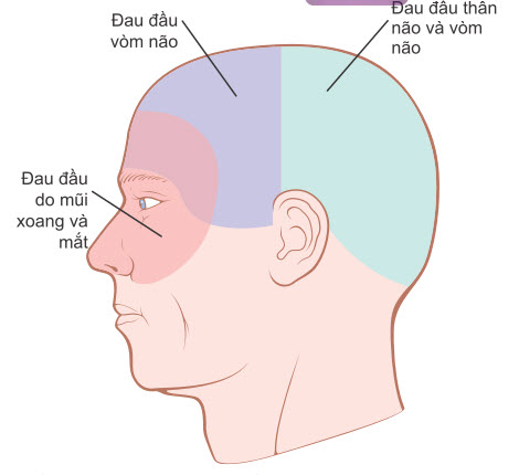 Các vùng đau đầu do các nguyên nhân khác nhau