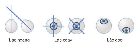 Các dạng lác cơ bản