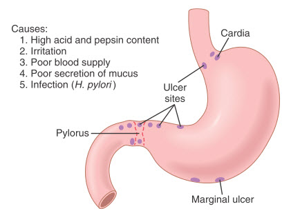 Loét dạ dày tá tràng