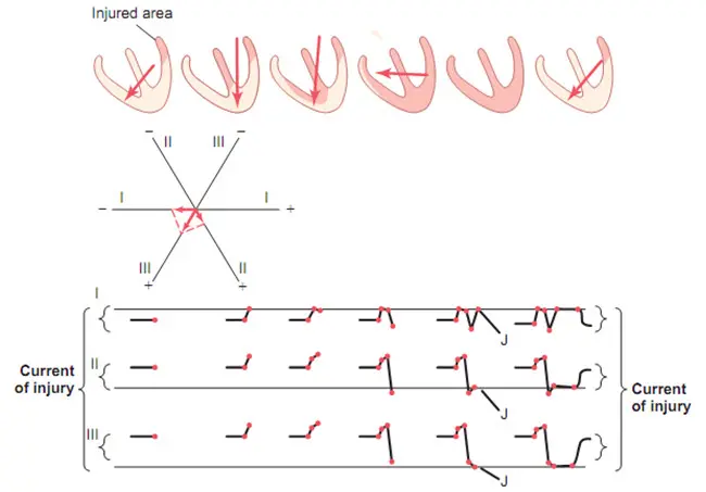 Ảnh hưởng của dòng điện của tổn thương trên điện tâm đồ