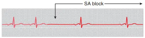 Block nút xoang nhĩ (SA), với nhịp nút nhĩ thất khi block (đạo trình DIII)