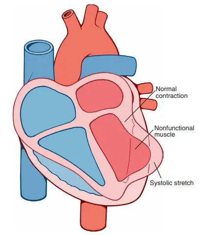 Căng tâm thu ở một vùng cơ tim thiếu máu cục bộ