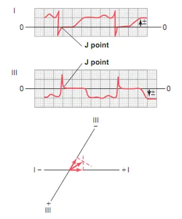 Điểm J là điểm đẳng điện của điện tâm đồ trên chuyển đạo I và III